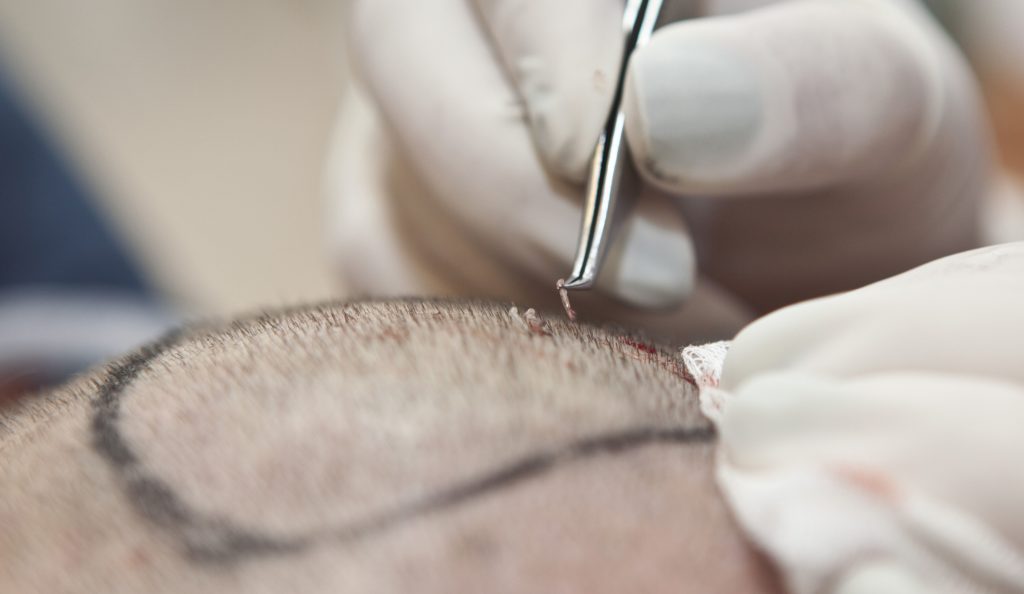 hair transplant